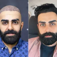 کاشت تخصصی مو و ابرو فقط یک روز در مشهد