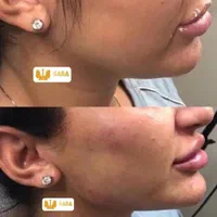 تزریق ژل و بوتاکس|خدمات آرایشگری و زیبایی|اهواز, نادری|دیوار