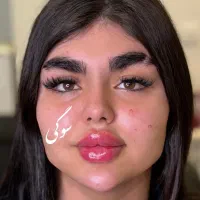 تزریق ژل و بوتاکس