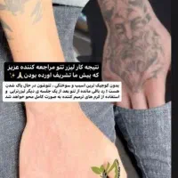 لیزر تاتو وخالکوبی ،جای جوش بخیه زخم،اندولیفت|خدمات آرایشگری و زیبایی|فولادشهر, B5|دیوار