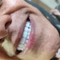 دندان مصنوعی وارداتی هر فک ۵ تومان