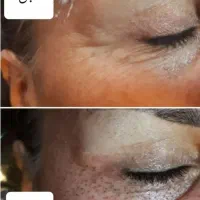 مزونیدلینگ کل صورت و پاکسازی وخالبرداری وآموزش|خدمات آرایشگری و زیبایی|یزد, |دیوار
