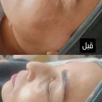 فیشال حرفه ای با دستگاه..|خدمات آرایشگری و زیبایی|گرگان, |دیوار
