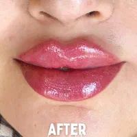 فیلر ژل بوتاکس نخ لیفت و جوانساز زاویه هایفو|خدمات آرایشگری و زیبایی|فردیس, فردیس|دیوار
