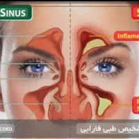 درمان سینوزیت
