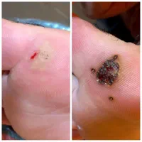 برداشتن خال.زگیل تناسلی.جای زخم و بخیه. میخچه|خدمات آرایشگری و زیبایی|کرمانشاه, |دیوار