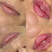 تخفیفات ویژه آموزش فیلر(ژل)، بوتاکس،لیفت بانخ