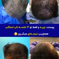رفع کمپشتی مو با تکنیک میکرو اسکالپ /مکمل کاشتمو|خدمات آرایشگری و زیبایی|مشهد, احمدآباد|دیوار