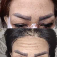 لیزر خال /میخچه زگیل/ ژل بوتاکس|خدمات آرایشگری و زیبایی|قم, صفائیه|دیوار