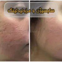 آنزیم ژل فیلر مزو بوتاکس فیشیال لابیا تنگی هودکتوم|خدمات آرایشگری و زیبایی|مشهد, آزادشهر|دیوار