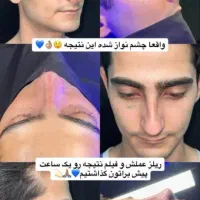 فرصت استثنایی وباورنکردنی عمل بینی بصورت اقساط|خدمات آرایشگری و زیبایی|ایذه, |دیوار