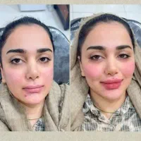 جشنواره آموزشی حرفه ی ژل+بوتاکس+آنزیم مناسب