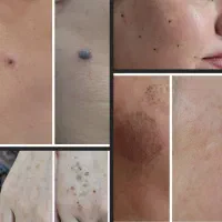 اموزش خدمات پلاسما کک ومک لک خال مزو کرمپودردائم|خدمات آرایشگری و زیبایی|قم, زنبیل آباد|دیوار
