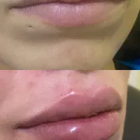 بوتاکس(۸۰۰)|خدمات زیبایی و سلامت|تهران, دولتآباد|دیوار