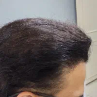 کاشت مو تخصصی|خدمات آرایشگری و زیبایی|اسکو, |دیوار