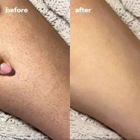 فیلر ، بوتاکس ، فیشال ، لیزر ، پی آر پی|خدمات آرایشگری و زیبایی|اندیشه, اندیشه فاز ۱|دیوار