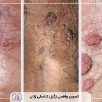 پک درمان زگیل تناسلی کاملا گیاهی و صددرصد تضمینی|آرایشی، بهداشتی، درمانی|کرمانشاه, |دیوار