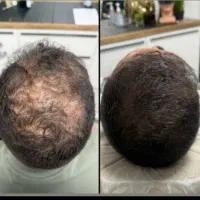 بخدا این روش بهتر از کاشته|آرایشی، بهداشتی، درمانی|اصفهان, جامی|دیوار