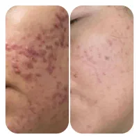 فیشال تخصصی.پاکسازی.کربوکسی.پلاژن تراپی.اسیدتراپی