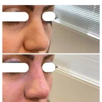 مطب‌پوست مو لیزر و‌لاغری