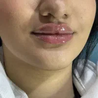 تزریق ژل بوتاکس هایفوتراپی بلفاروپلاستی توسط پزشک|خدمات آرایشگری و زیبایی|تبریز, |دیوار