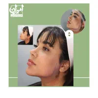ساکشن غبغب فقط با 15800 + گن رایگان روش وی لاین