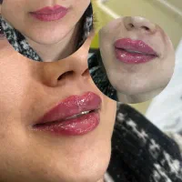 تزریق ژل،لیزر،بوتاکس|خدمات آرایشگری و زیبایی|تهران, یافت‌آباد|دیوار