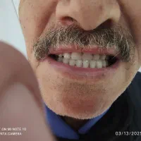 ساخت انواع دندان های مصنوعی متحرک و لثه ژله ای|آرایشی، بهداشتی، درمانی|شیراز, اصلاحنژاد|دیوار