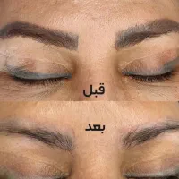 مدل جهت ریموو تتوهای قدیمی