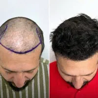 کاشت مو تخصصی قیمت ویژه جشنواره