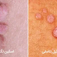 کلینیک درمان زگیل تناسلی HPV وانوع خال های گوشتی