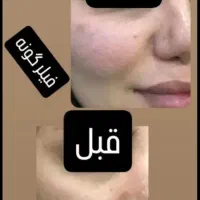 ژل لب گونه چونه زاویه مادلینگ راویه سازی|خدمات آرایشگری و زیبایی|قم, تولید دارو و یخچال|دیوار
