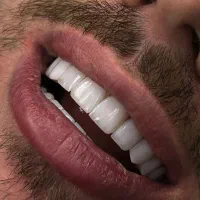 خدمات زیبایی دندان|خدمات آرایشگری و زیبایی|تهران, ولنجک|دیوار