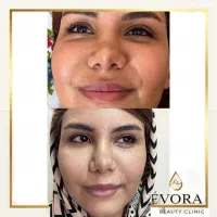 بوتاکس و فیلر اصل با تخفیف ویژه، زیرنظر پزشک