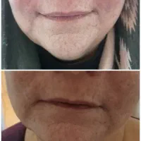 لیفت صورت و جوانسازی در یک جلسه|خدمات آرایشگری و زیبایی|شیراز, زند|دیوار