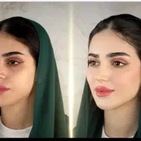 تزریق ژل بوتاکس فیلربادی باسن بیکینی هیپ دیپ لیفت|خدمات زیبایی و سلامت|تبریز, |دیوار