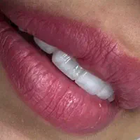 ایمپلنت فوری با 7ملیون تومان تخفیف  با اقساط 2ساله