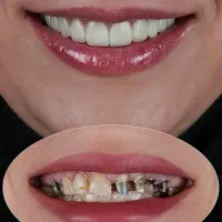ایمپلنت و روکش اقساطی دندانپزشکی در خرم آباد|خدمات آرایشگری و زیبایی|اندیمشک, |دیوار