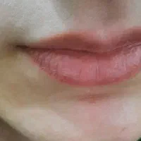 مدل برای تزریق ژل وفیلر