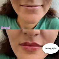 تزریق ژل و بوتاکس و مزو ( جوانسازی و روشن کننده)|خدمات آرایشگری و زیبایی|اهواز, گلستان|دیوار