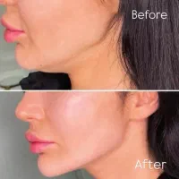 آموزش تزریق فیلر،بوتاکس و لیزر توسط پزشک