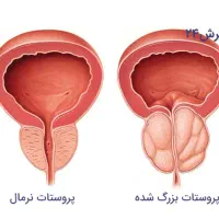 روغن پروستات
