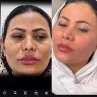 کرم لک سفید کننده فیلیپینی