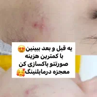 درماپلنینگ تخصصی صورت|خدمات آرایشگری و زیبایی|زابل, |دیوار