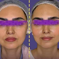 اقساطی زیباتر شو لیپو ابدو بلفارو فیس لیفت