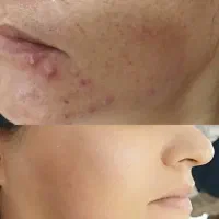 جوانسازی فوق معجزه صورت