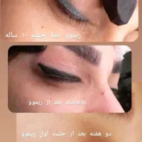 مرکز تخصصی پاک کردن تتو/میکرو،فیبروز ،شیدلب،آموزش|خدمات آرایشگری و زیبایی|گرگان, |دیوار