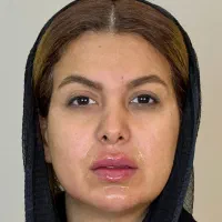 خدمات زیبایی. . فیلر مزوژل بوتاکس