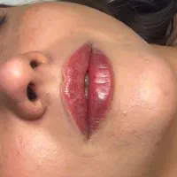 جشنواره خدمات زیبایی فیلر، بوتاکس و ...