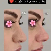لوسیون لیفت وکوچیک کننده بینی تضمینی وبدون عوارض|آرایشی، بهداشتی، درمانی|کرمانشاه, |دیوار
